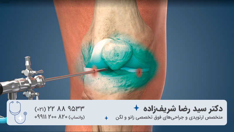 درمان مینیسک زانو