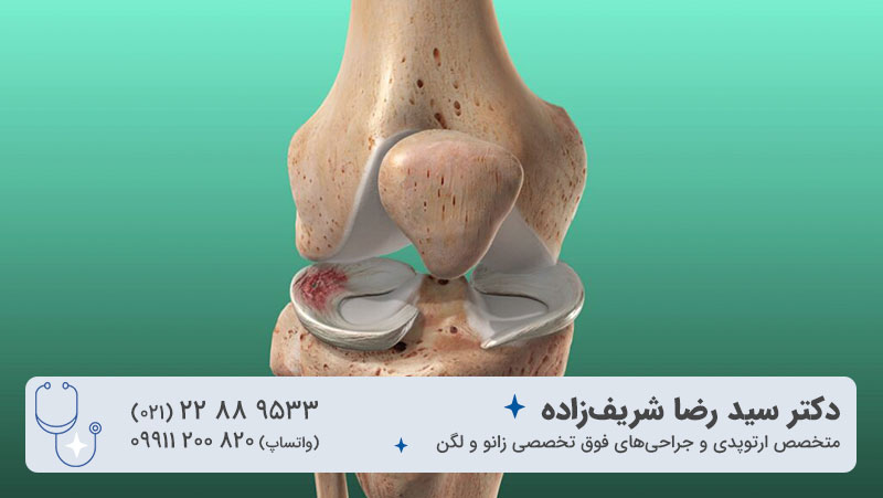 پارگی و آسیب مینیسک زانو