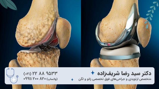 پروتز زانو چیست و چه کاربردی دارد؟