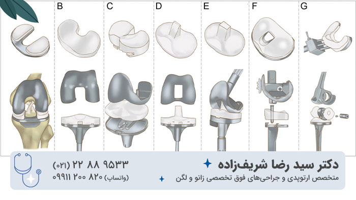 انواع پروتز زانو