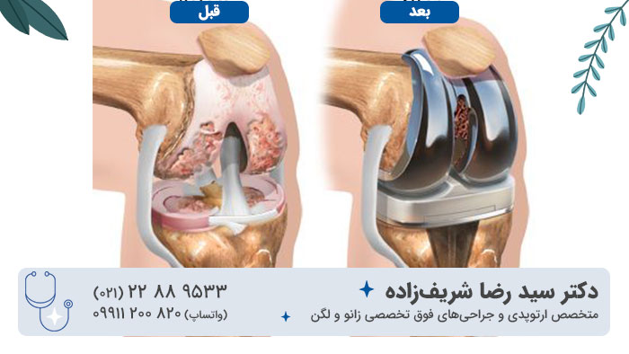 قبل و بعد پروتز زانو و طول عمر آن