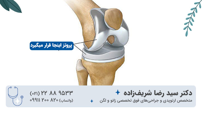 پروتز زانو