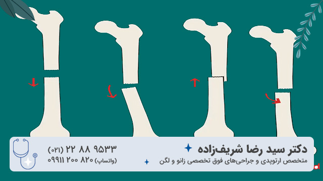 شکستگی استخوان با یا بدون جابه‌جایی