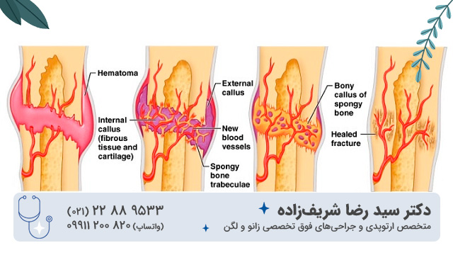 آیا استخوان شکسته مثل اول می شود