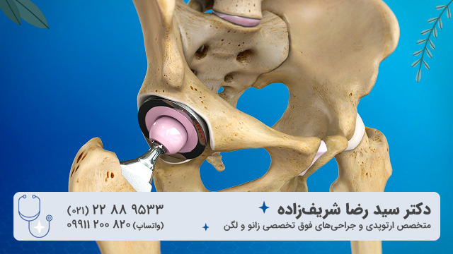 طول عمر پروتز لگن چه مدت است