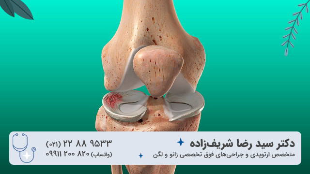 وظیفه مینیسک زانو چیست