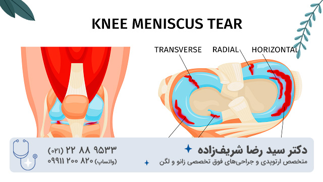 پارگی مینیسک درجه 3