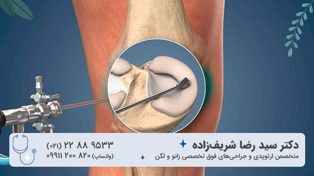 روش درمان مینیسک گرید 3