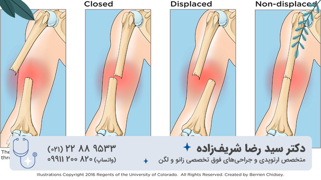 انواع شکستگی استخوان