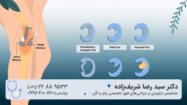 گرید بندی آسیب دیدگی مینیسک زانو