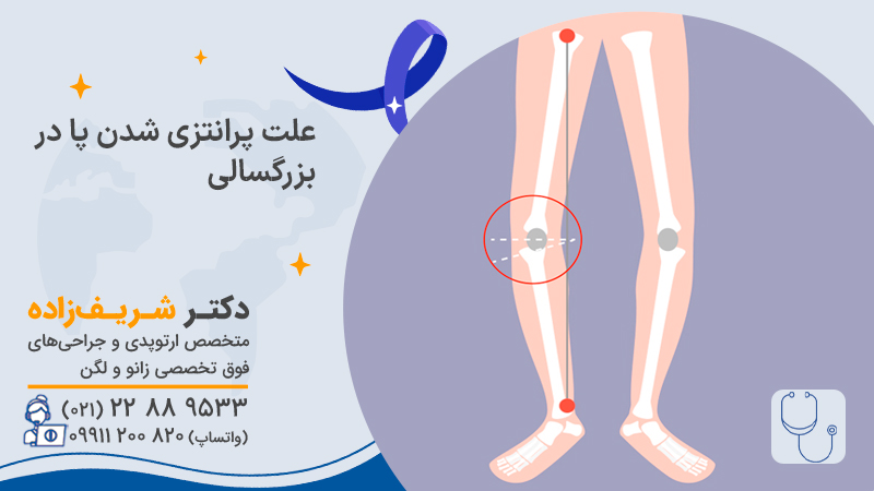 علت پرانتزی شدن پا در بزرگسالی