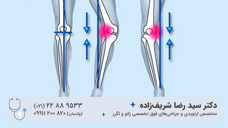 افزایش قد با اصلاح پای پرانتزی