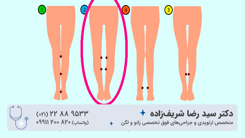 علت پرانتزی شدن پا در بزرگسالی