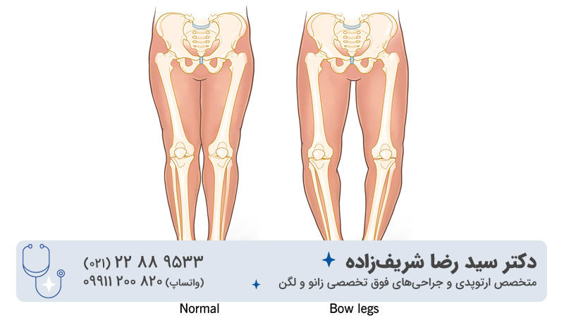 عکس پای پرانتزی و سالم