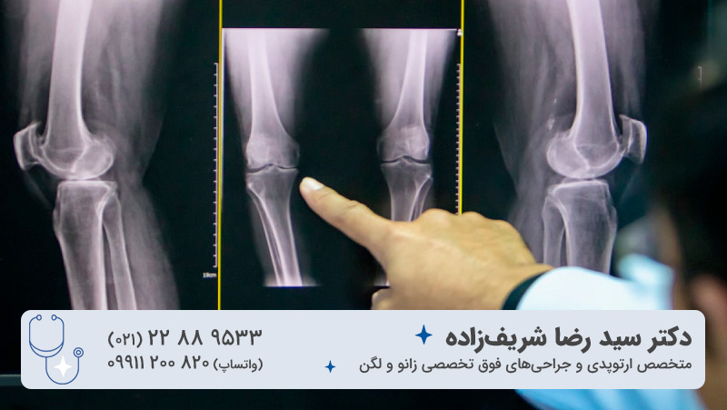 تشخیص علت پرانتزی شدن پا در بزرگسالی