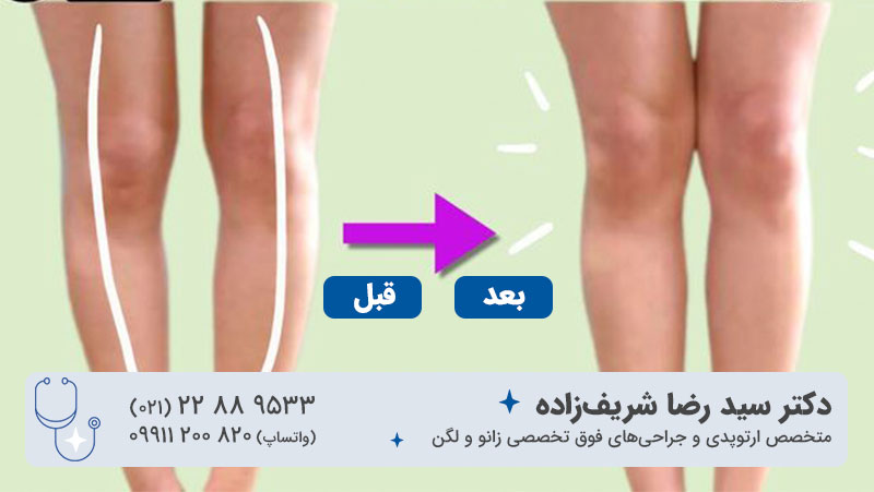 درمان پای پرانتزی چقدر طول میکشد؟