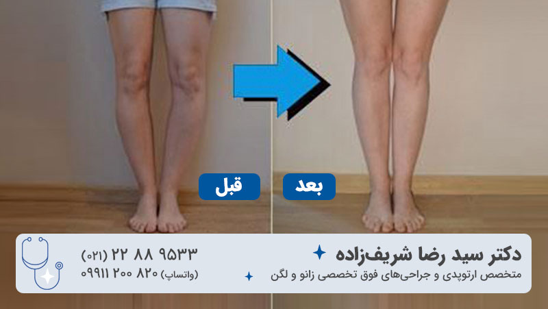 درمان پای پرانتزی با جراحی