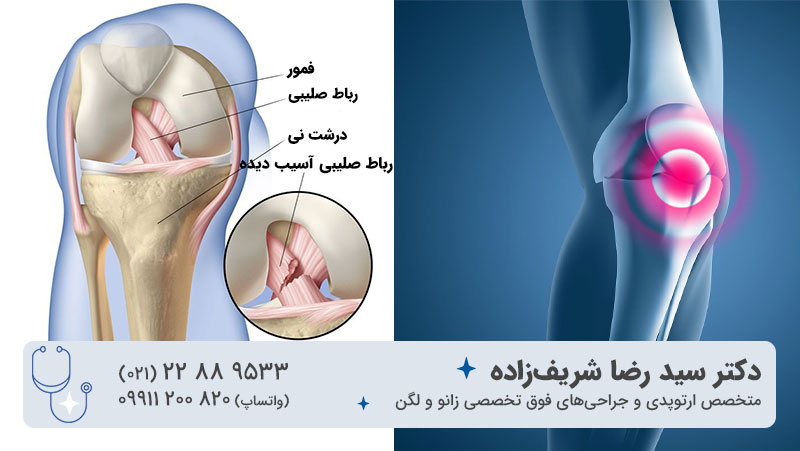 رباط صلیبی چیست