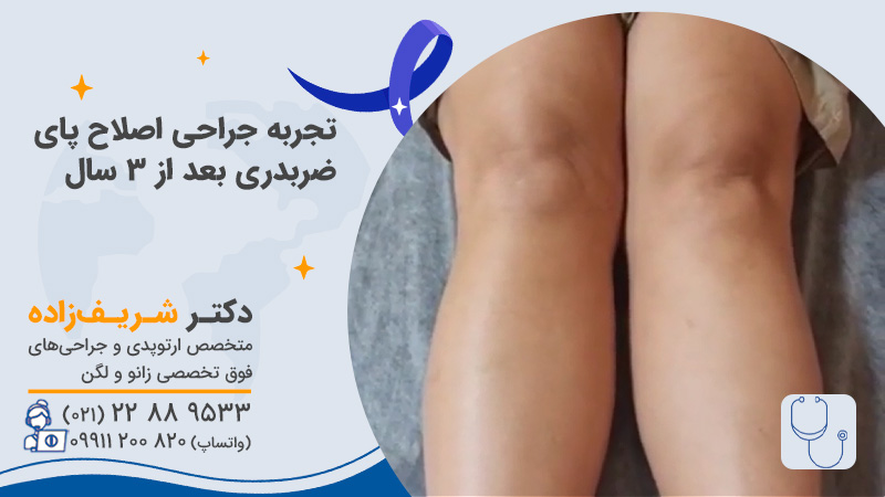 تجربه جراحی اصلاح پای ضربدری