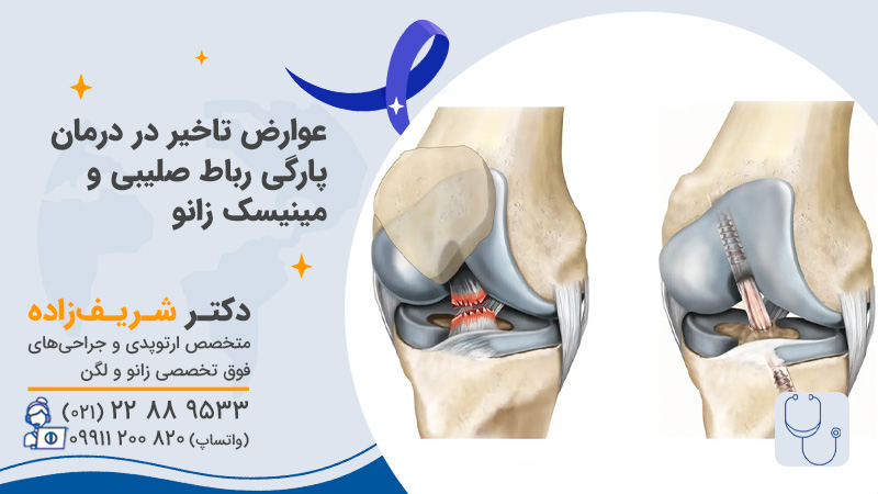 عوارض تاخیر در درمان پارگی رباط صیلبی و مینیسک