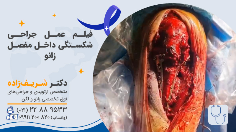فیلم عمل جراحی شکستگی داخل مفصل زانو