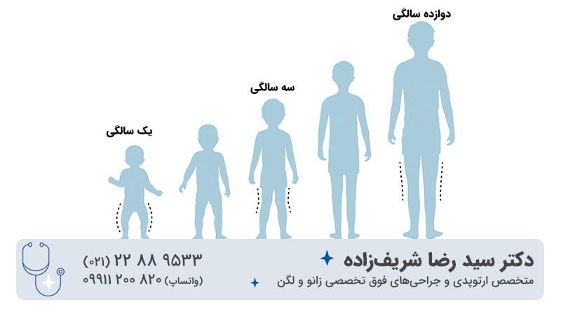 از کجا بفهمیم پای نوزاد پرانتزی است