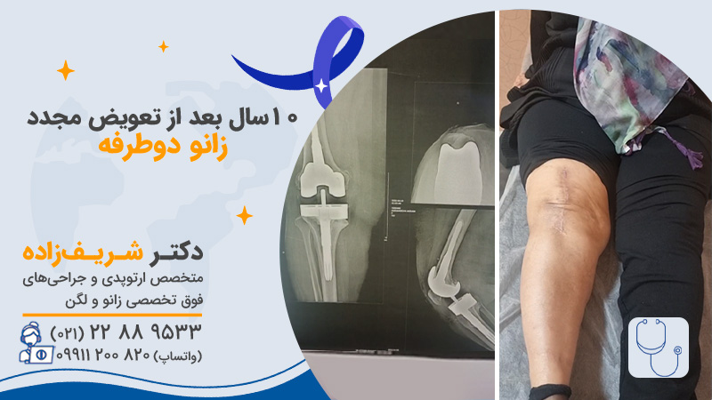 تعویض مفصل زانو چند سال دوام دارد