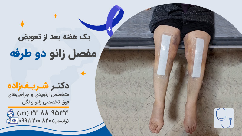 تعویض مفصل همزمان دو زانو برای چه افرادی انجام میشود؟