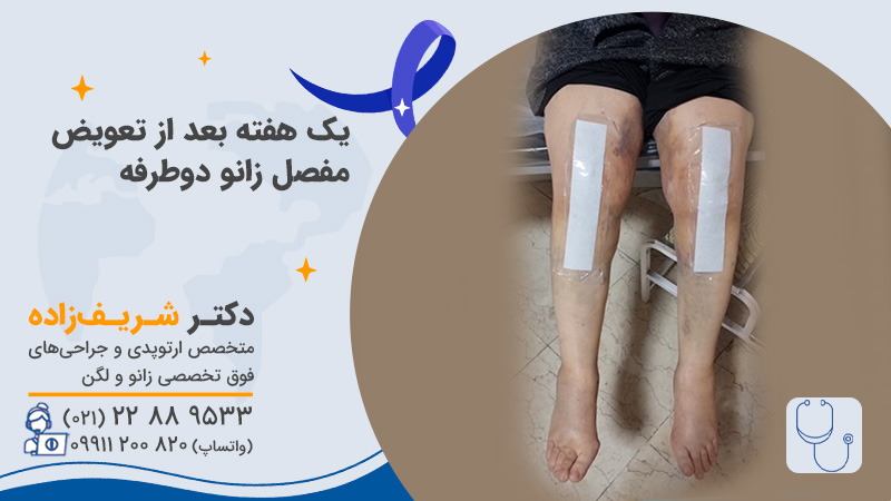 تعویض مفصل همزمان دو زانو