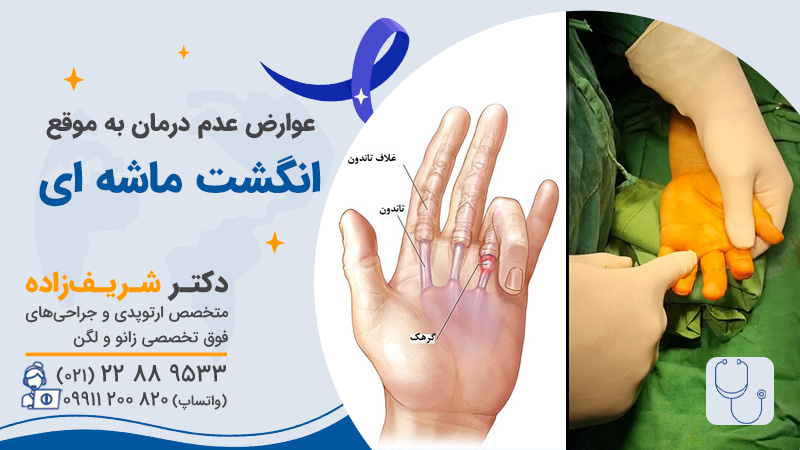انگشت ماشه ای