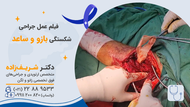 فیلم جراحی شکستگی ساعد دست و بازو