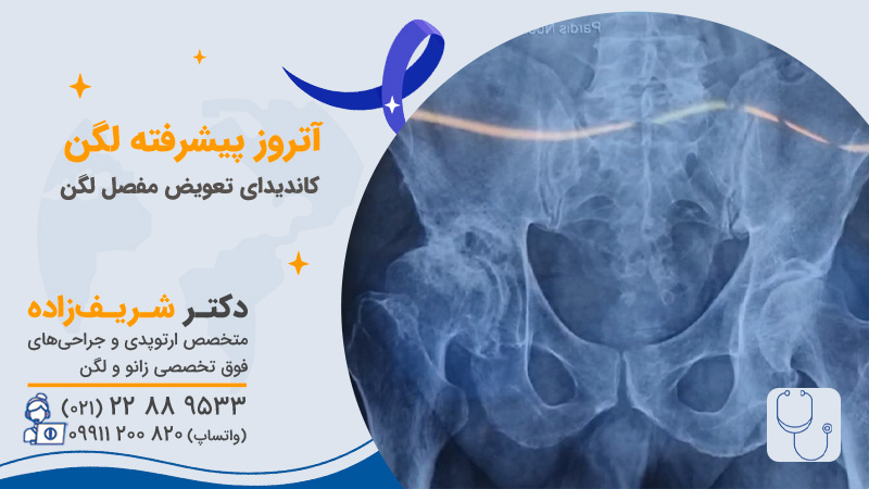 چه افرادی کاندید تعویض مفصل لگن هستند