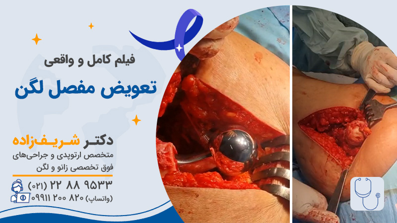 فیلم عمل جراحی تعویض مفصل لگن