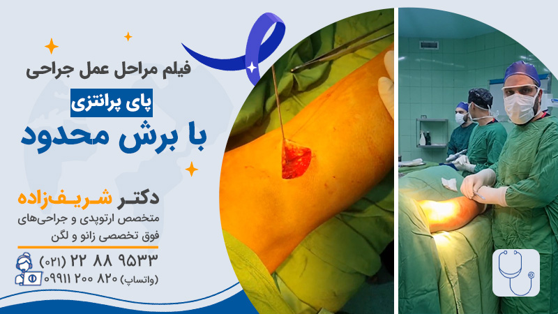 فیلم مراحل عمل جراحی پای پرانتزی با برش محدود