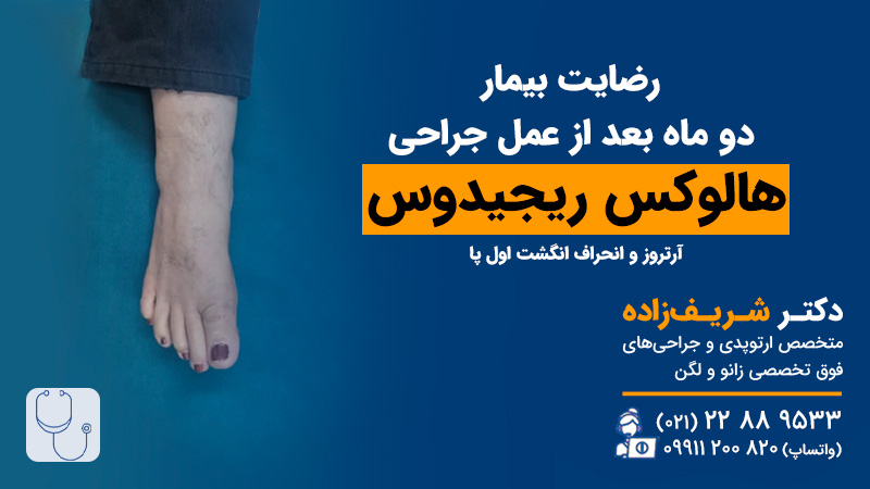 تجربه عمل هالوکس ریجیدوس