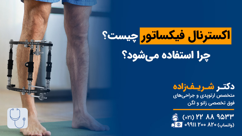 اکسترنال فیکساتور چیست