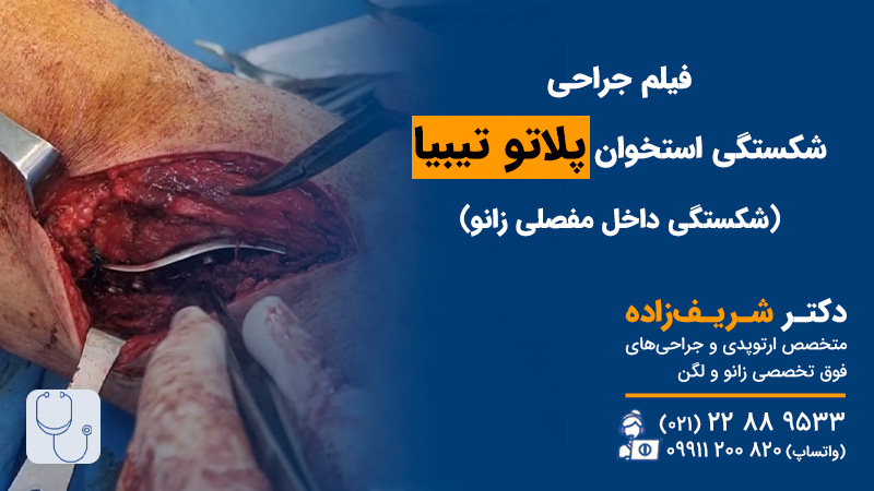 فیلم جراحی شکستگی پلاتو تیبیا آقای 47 ساله در تصادف با خودرو
