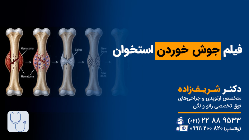 فیلم جوش خوردن استخوان