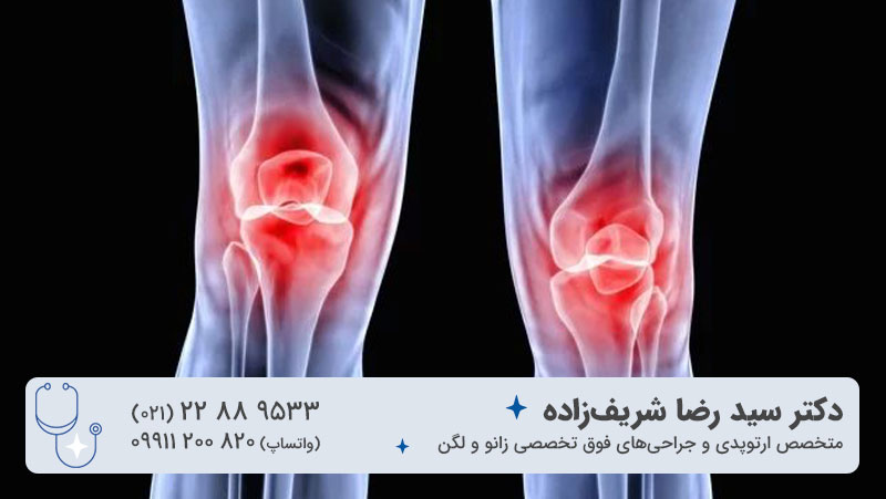 ساییدگی یا آسیب غضروف کشکک