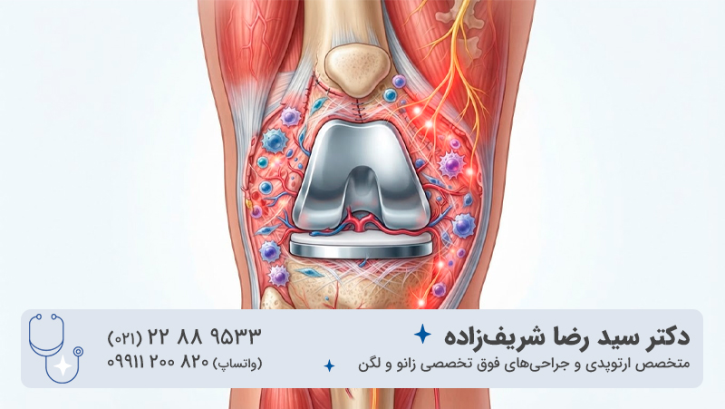 درد بعد از عمل تعویض مفصل زانو؛ چرا زانو هنوز درد دارد؟