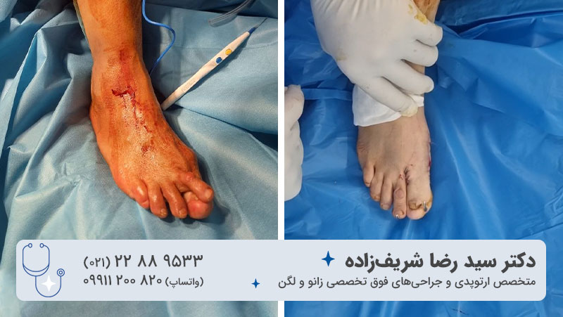 فیلم عمل جراحی انحراف شست پا خانم 60 ساله