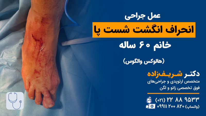 فیلم عمل جراحی انحراف شست پا خانم 60 ساله