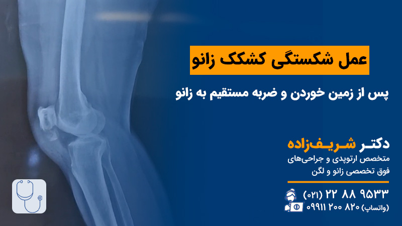 فیلم عمل کشکک زانو